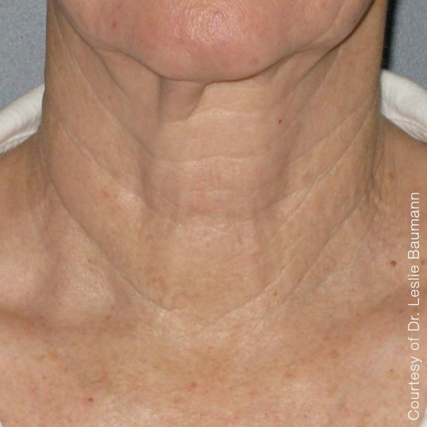 Ultherapy® - Neck: Patient 6 - After 1