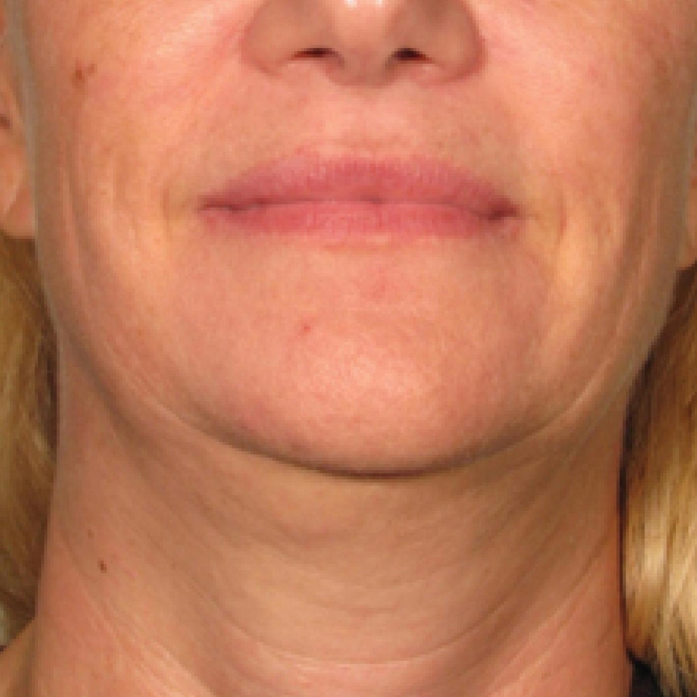 Ultherapy® - Chin: Patient 10 - Before 