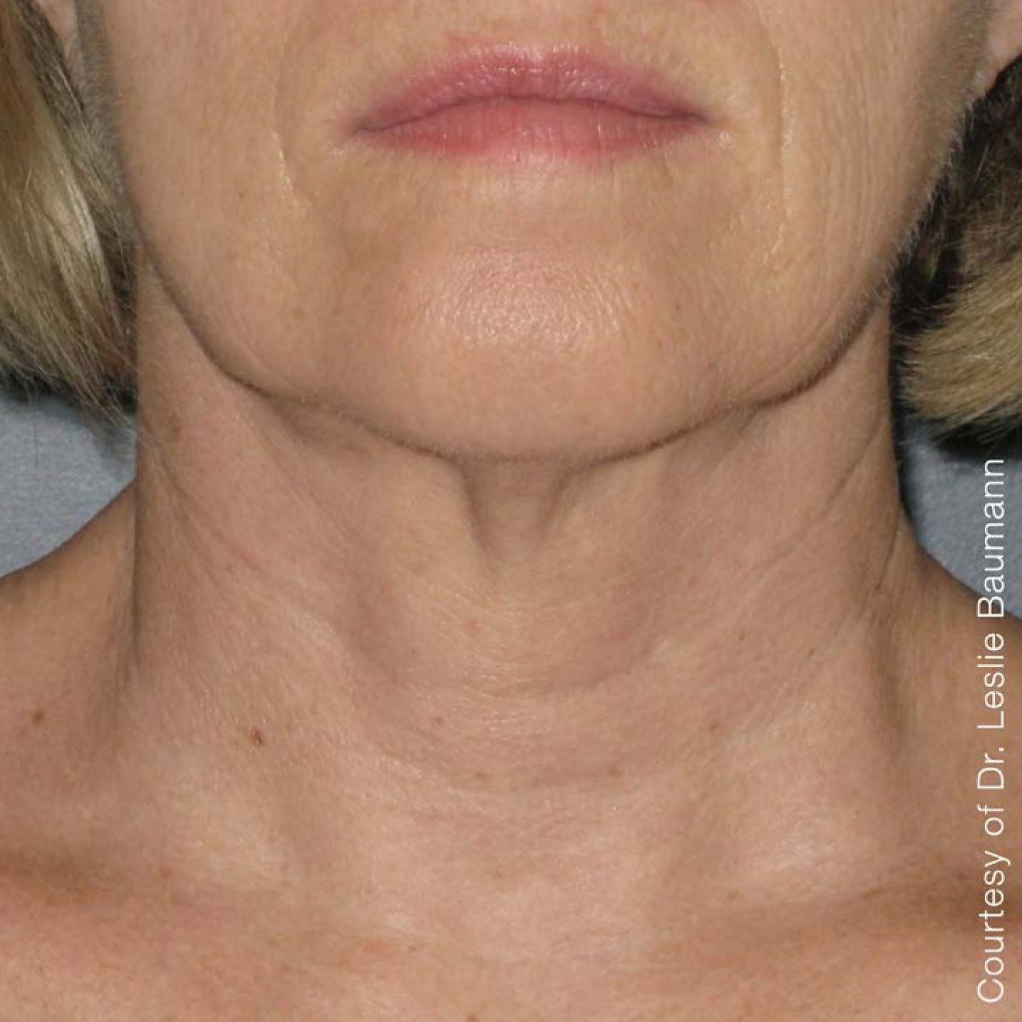 Ultherapy® - Neck: Patient 9 - After  