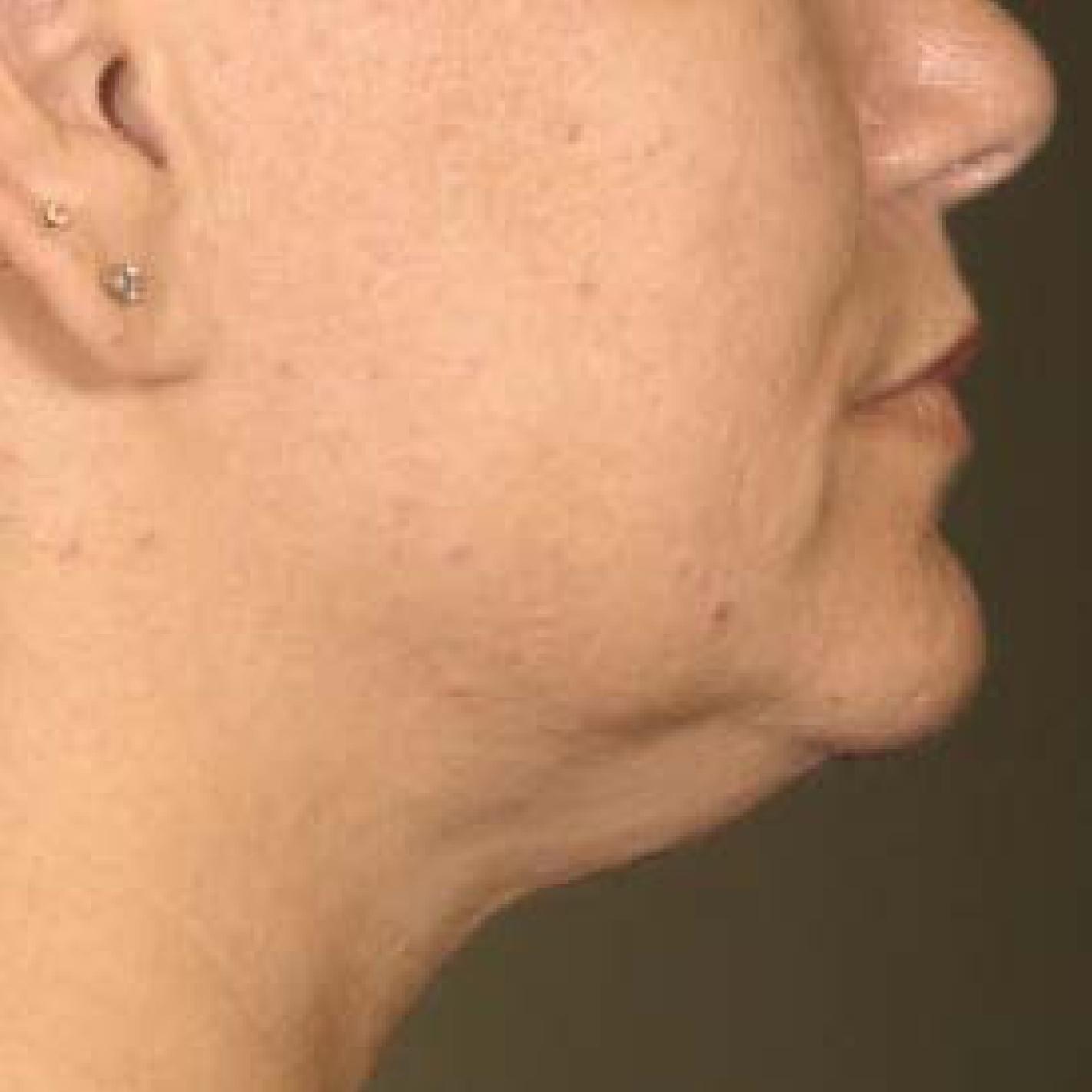 Ultherapy® - Chin: Patient 30 - After 1