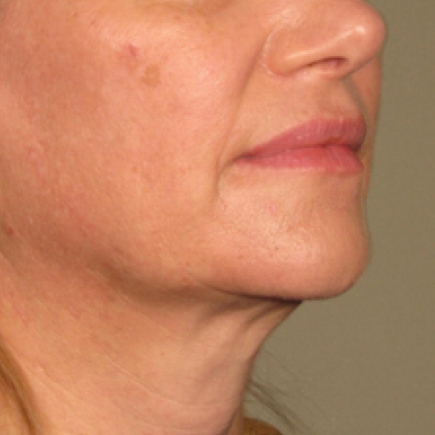 Ultherapy® - Chin: Patient 11 - After 