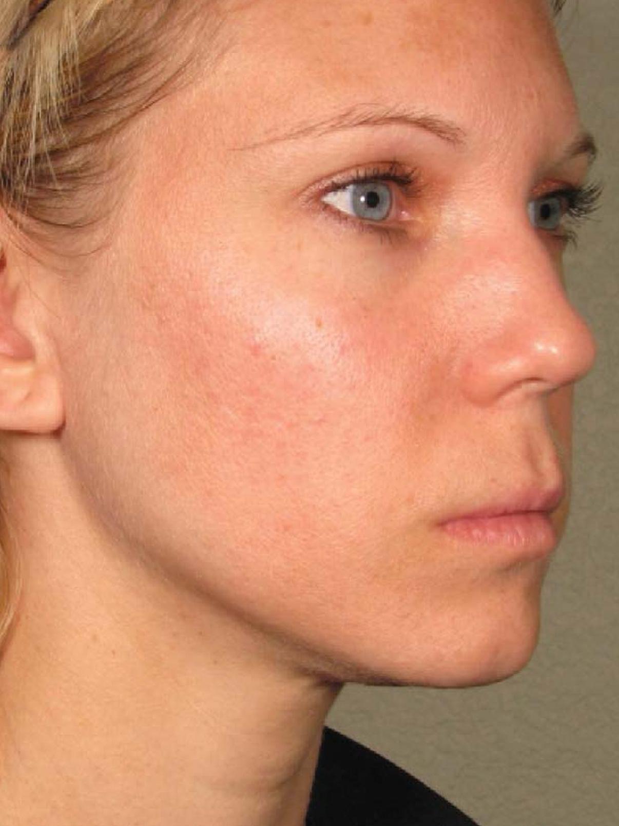 Ultherapy® - Face: Patient 11 - After 