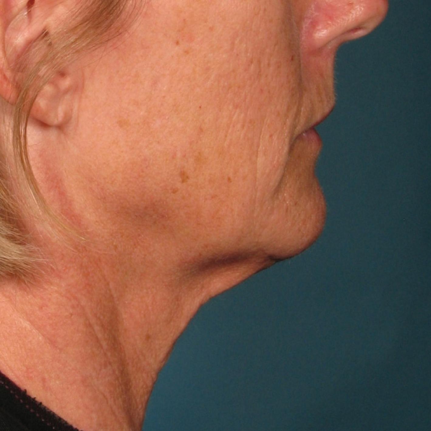 Ultherapy® - Chin: Patient 35 - After 1