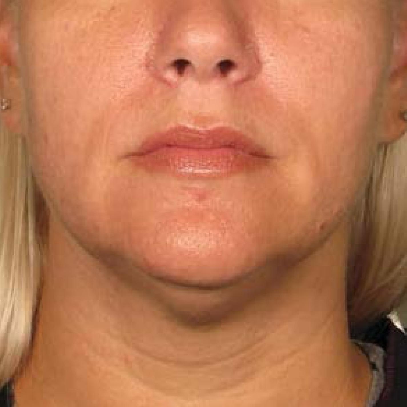 Ultherapy® - Chin: Patient 29 - After 