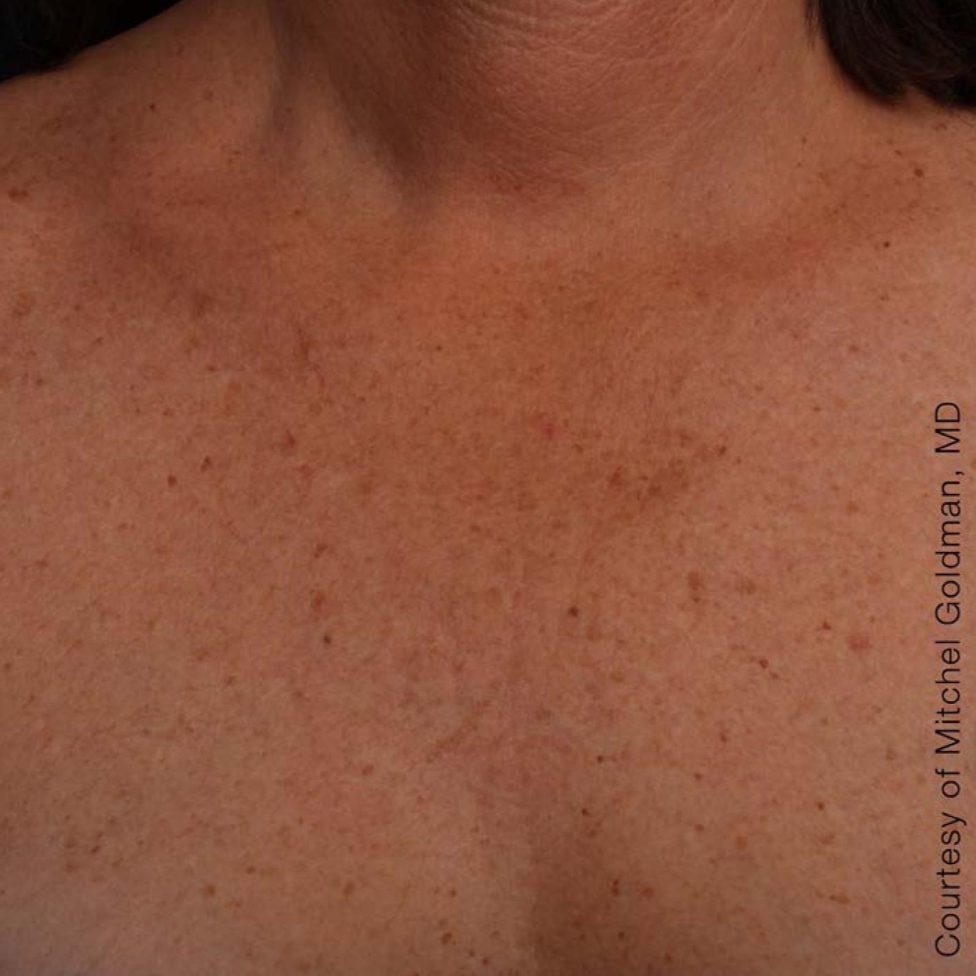Ultherapy® - Décolletage: Patient 14 - After 