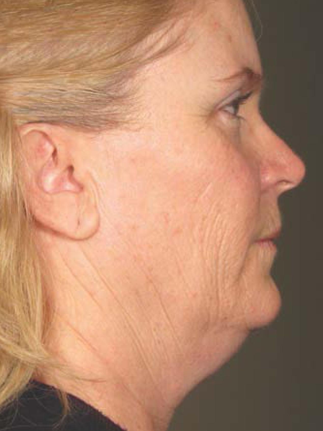 Ultherapy® - Face: Patient 18 - Before 