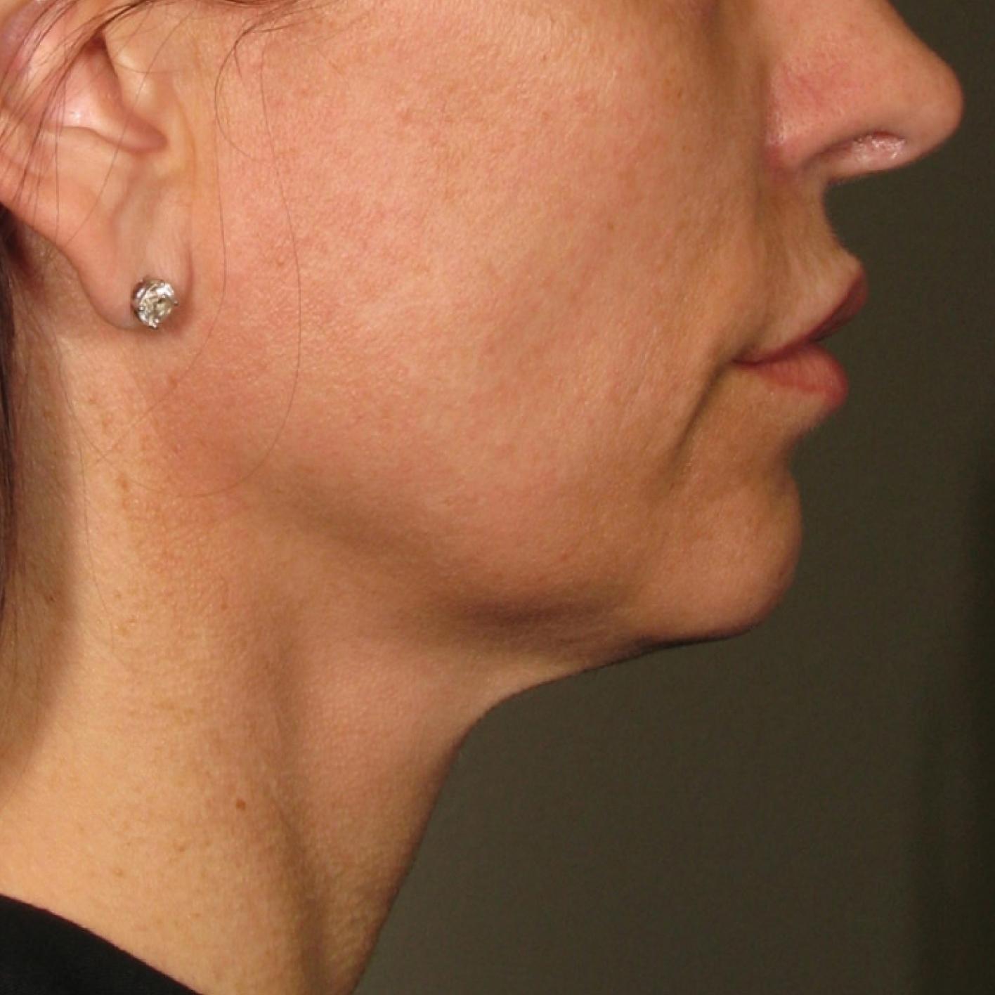 Ultherapy® - Chin: Patient 38 - After 1