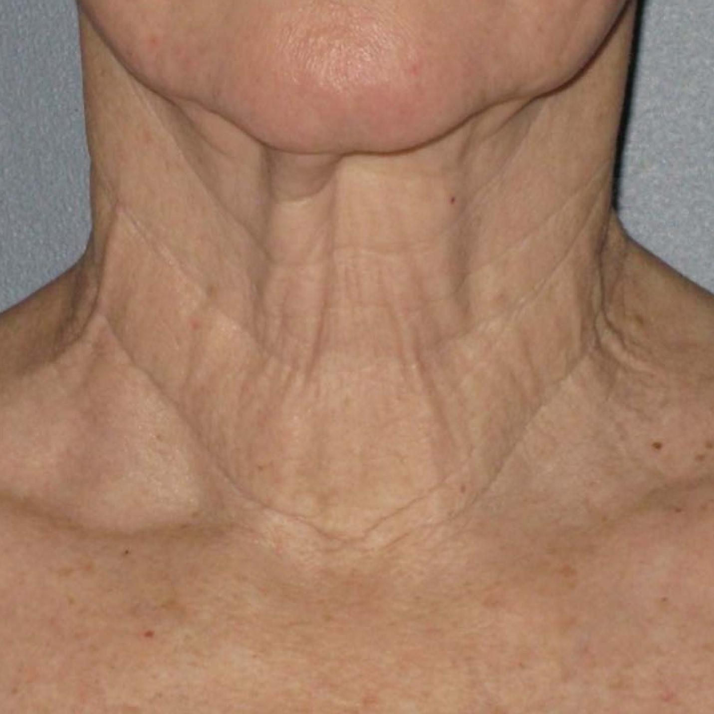 Ultherapy® - Neck: Patient 6 - After  