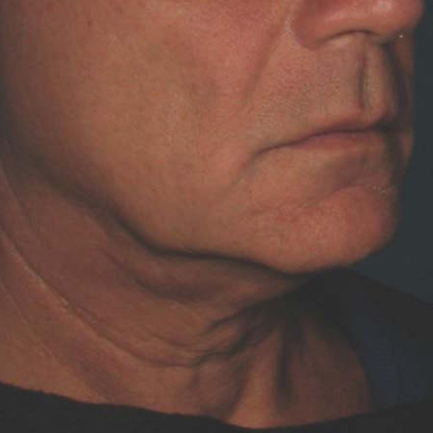 Ultherapy® - Chin: Patient 40 - Before 