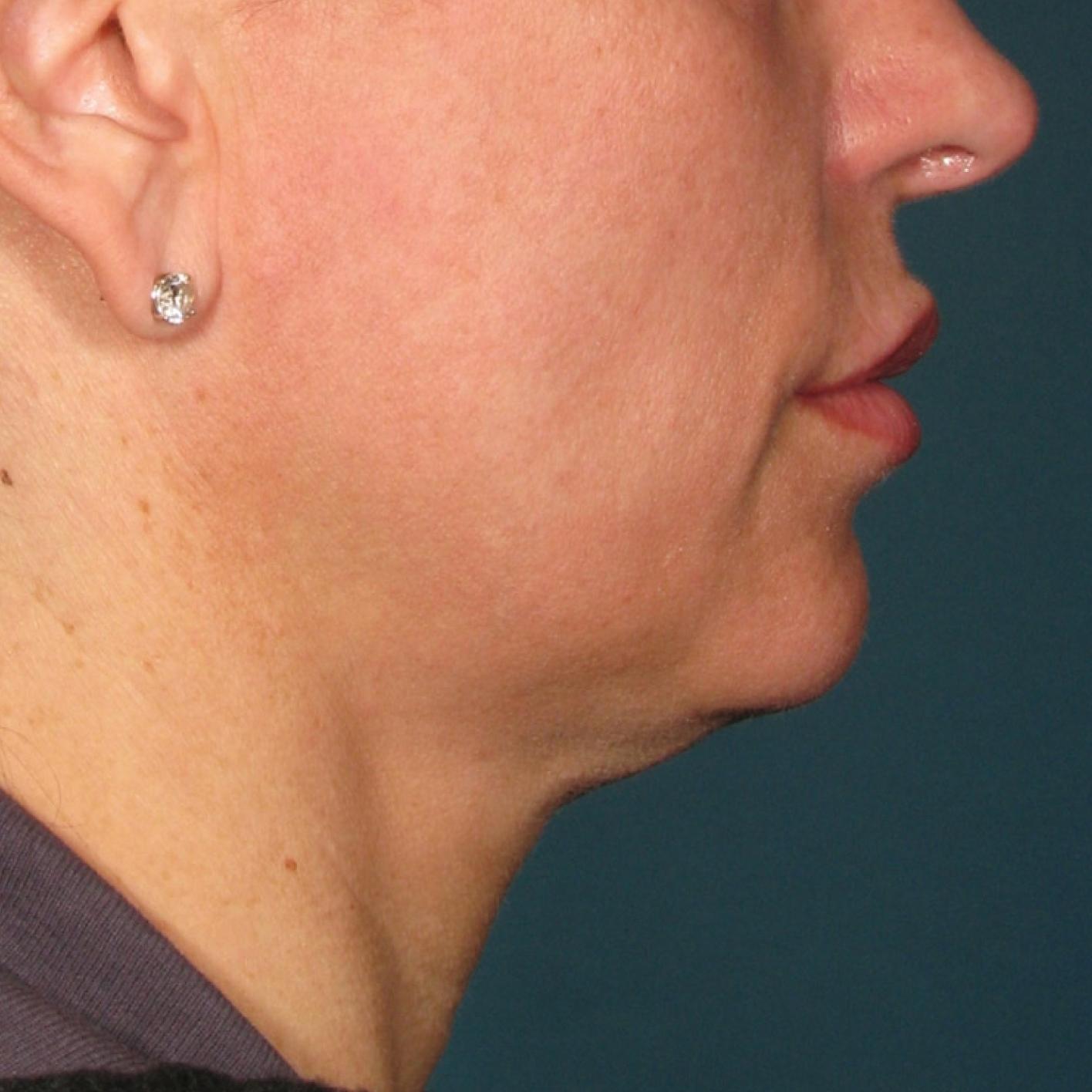 Ultherapy® - Chin: Patient 38 - Before 