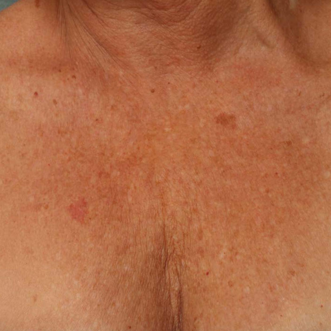 Ultherapy® - Décolletage: Patient 9 - Before 