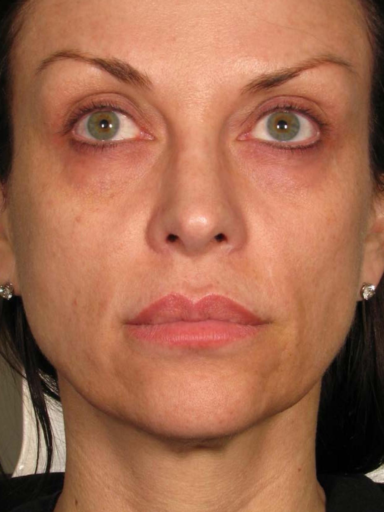 Ultherapy® - Face: Patient 23 - After 