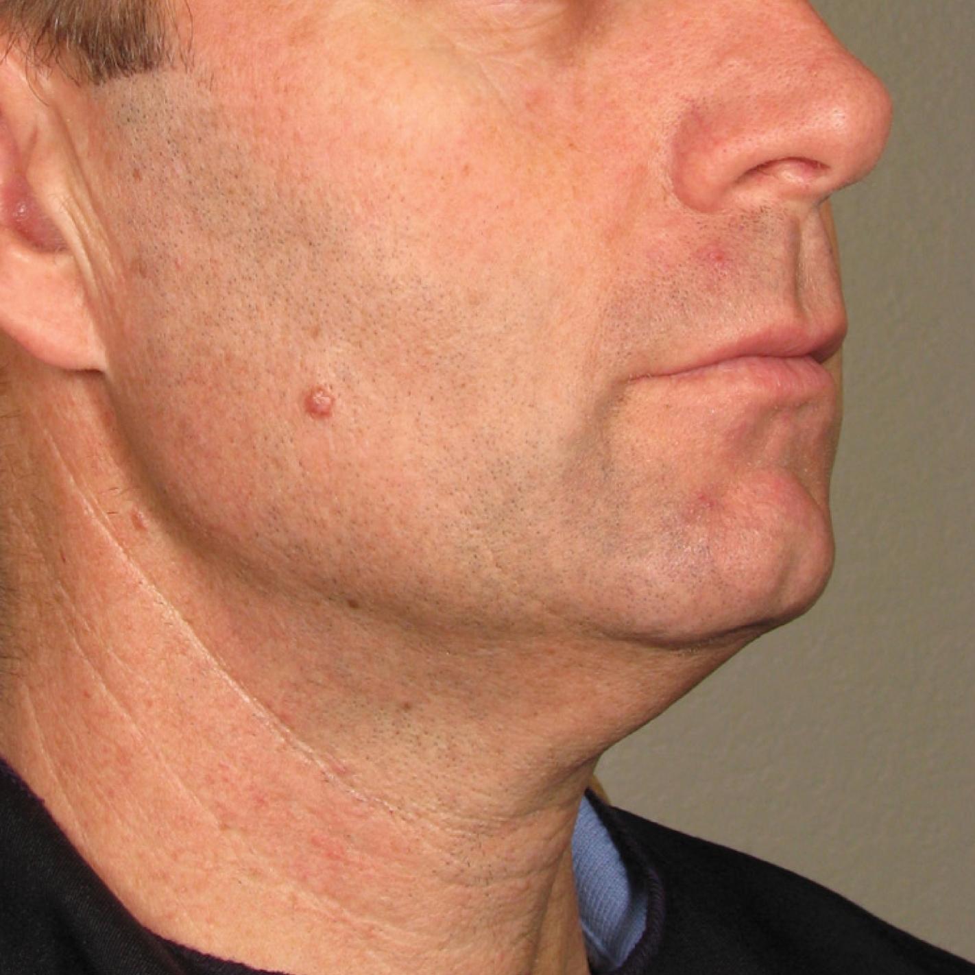 Ultherapy® - Chin: Patient 22 - After 