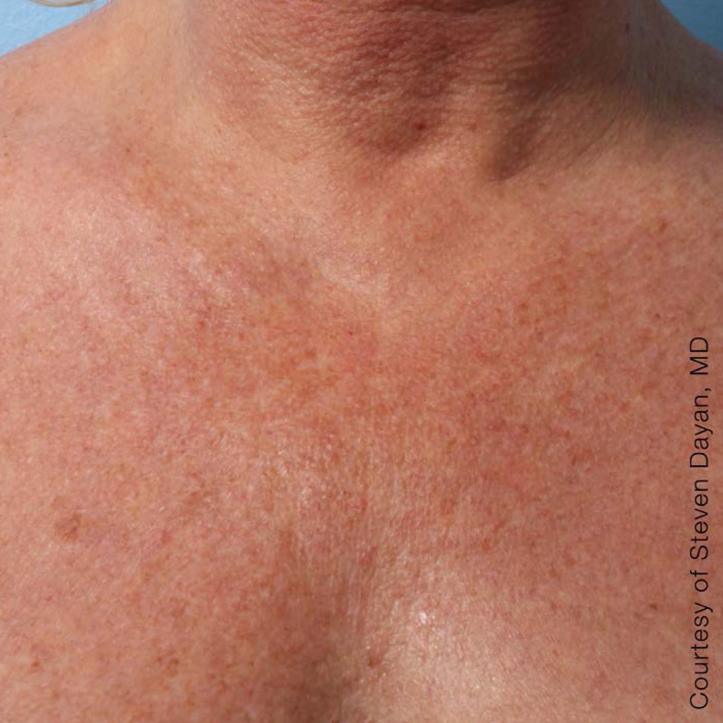 Ultherapy® - Décolletage: Patient 7 - After  