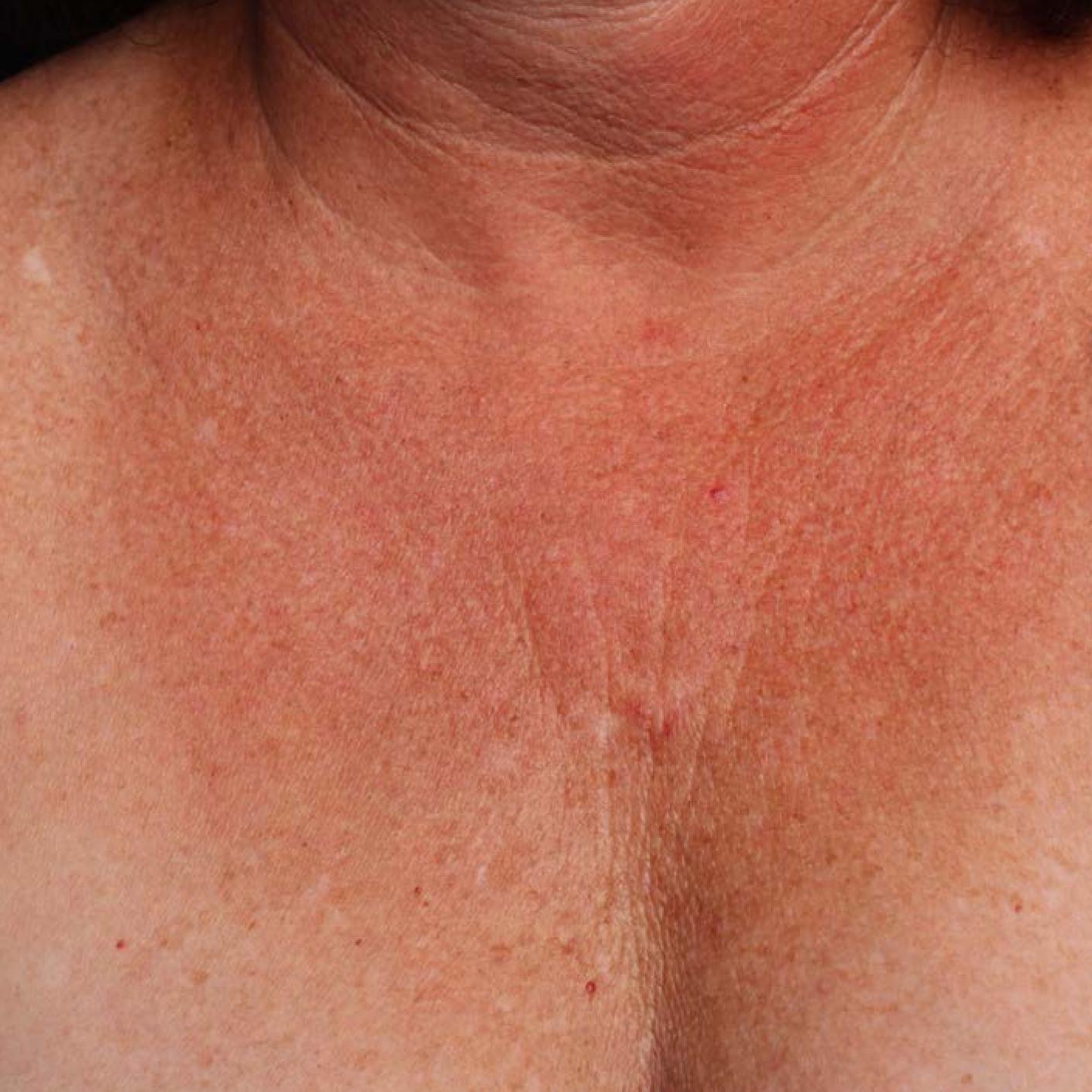 Ultherapy® - Décolletage: Patient 11 - Before 