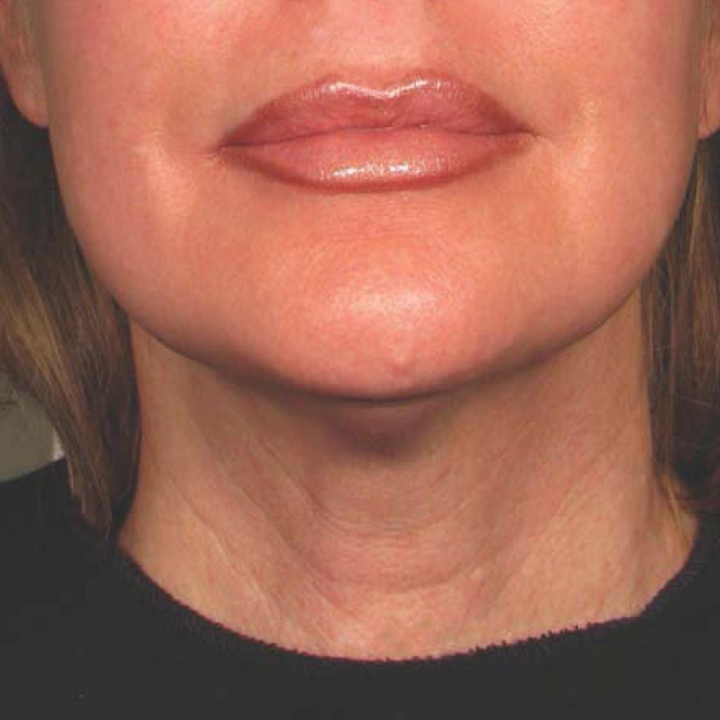 Ultherapy® - Chin: Patient 25 - After 1