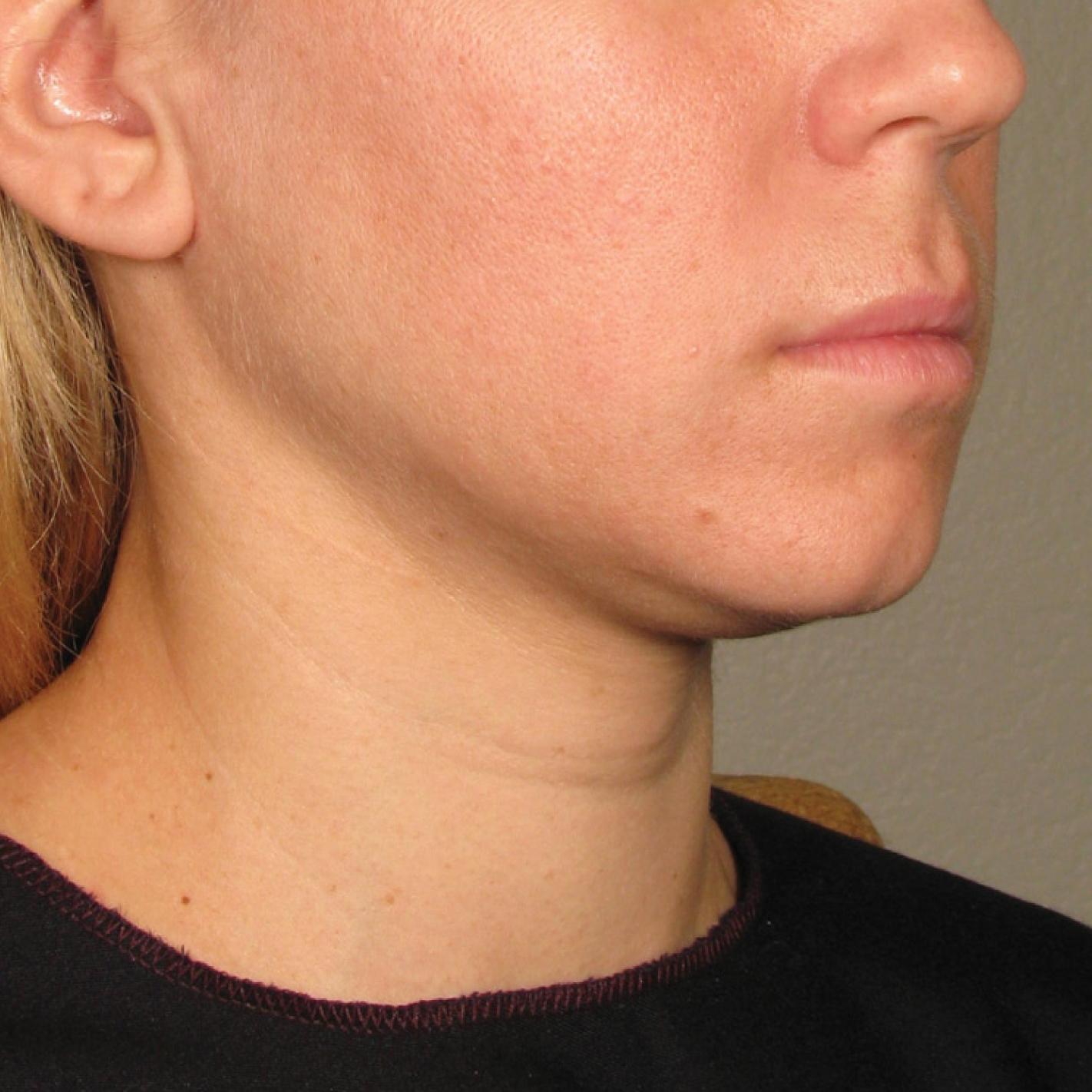 Ultherapy® - Chin: Patient 23 - Before 