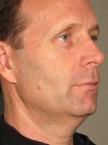 Ultherapy® - Face: Patient 10 - Before 