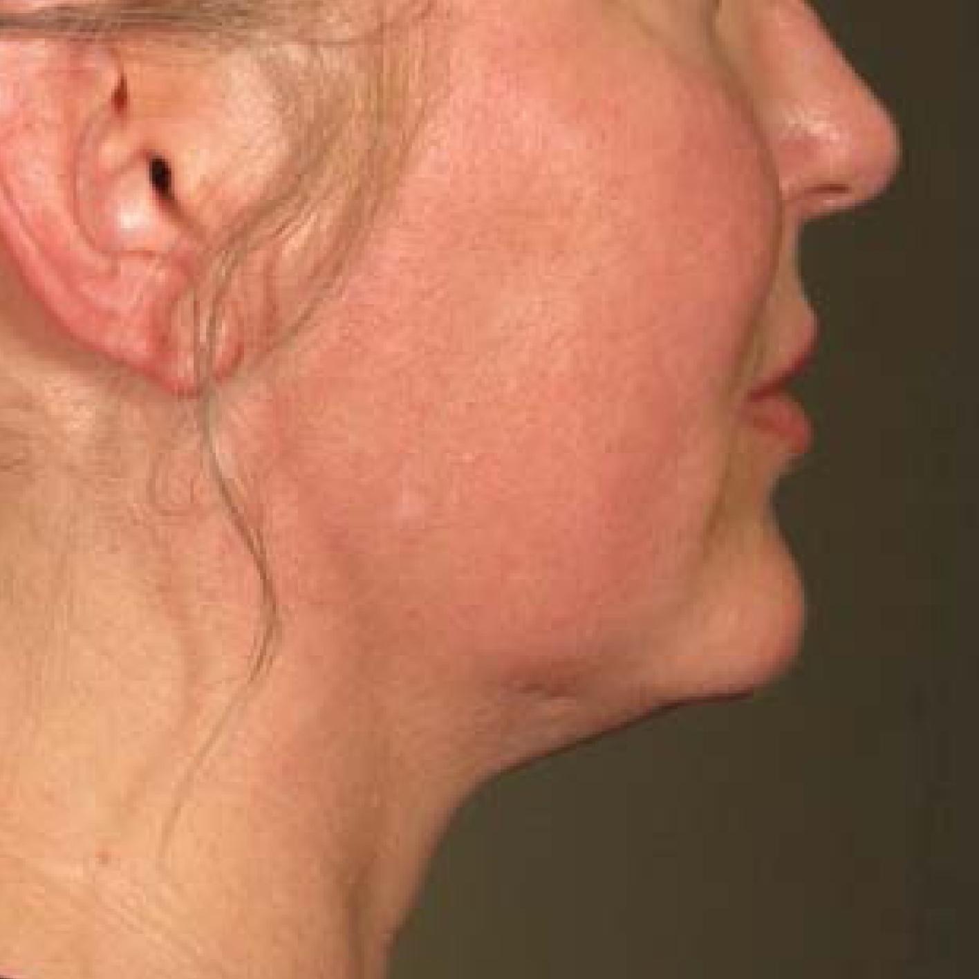 Ultherapy® - Chin: Patient 18 - After 