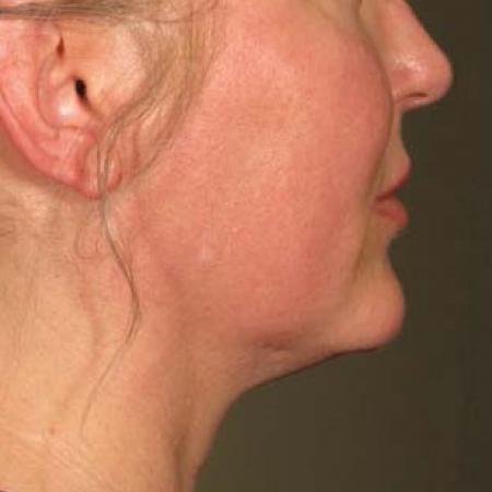 Ultherapy® - Chin: Patient 18 - After
