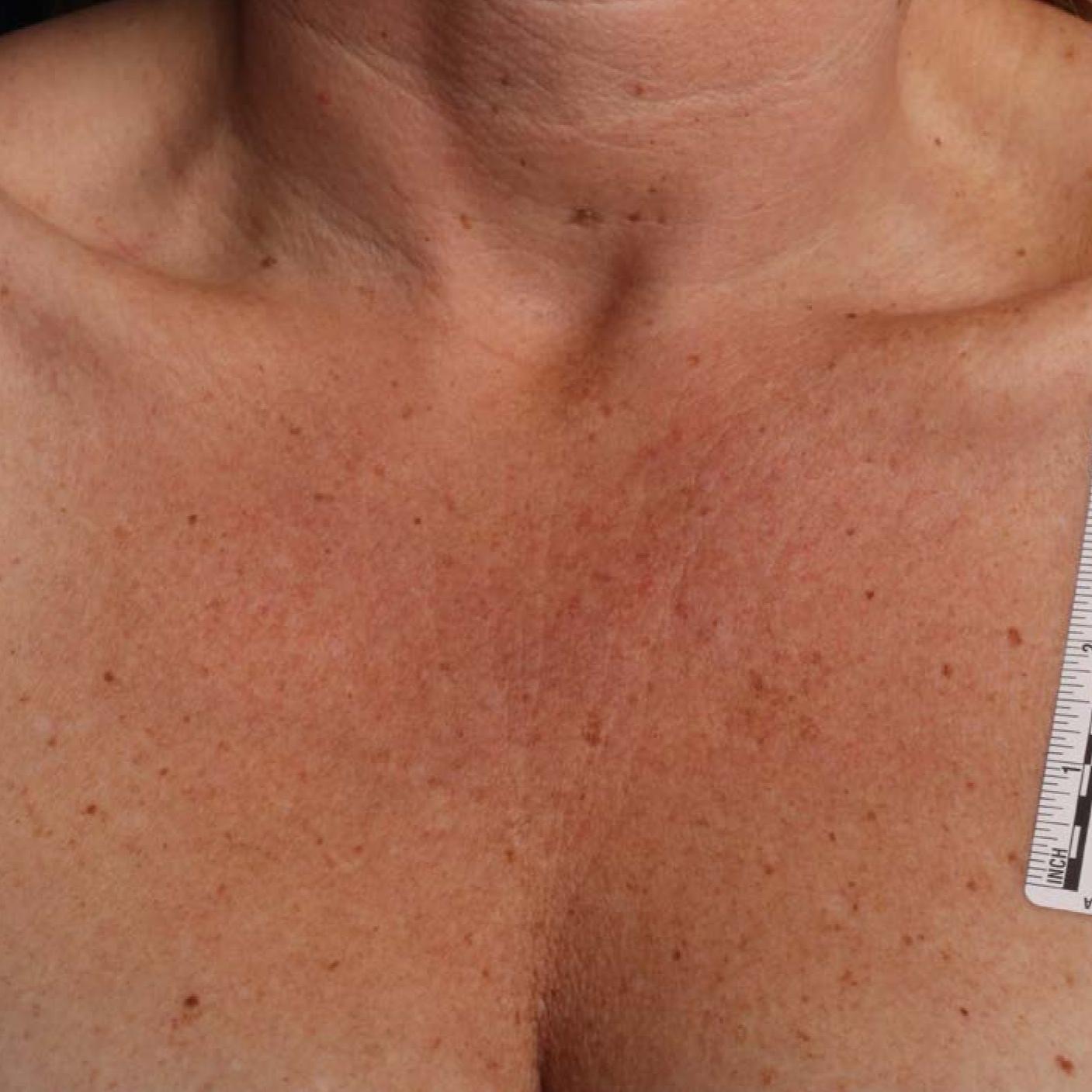 Ultherapy® - Décolletage: Patient 16 - Before 1