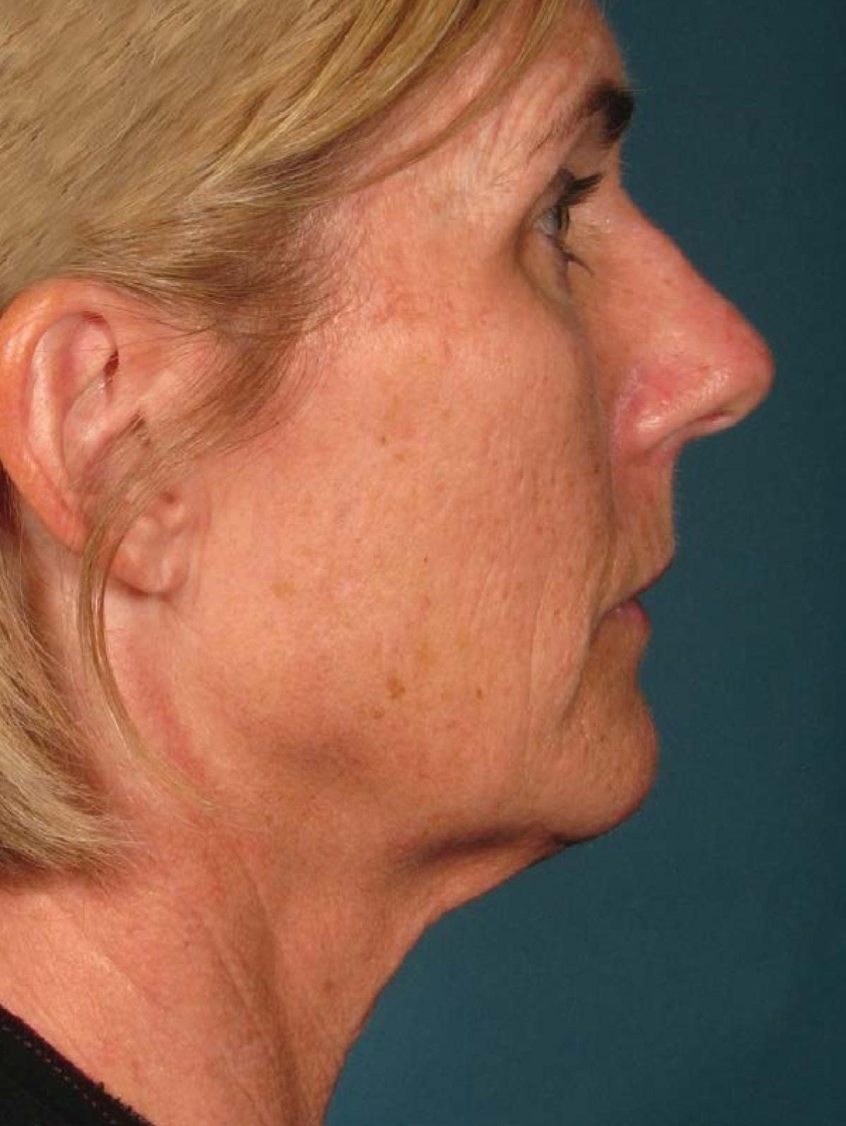 Ultherapy® - Face: Patient 15 - After 1