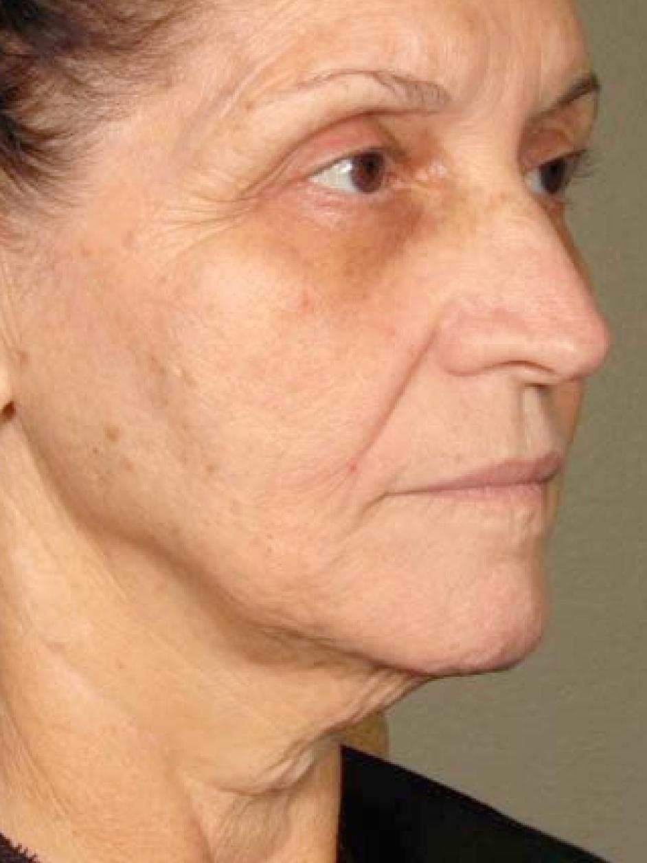 Ultherapy® - Face: Patient 1 - After  