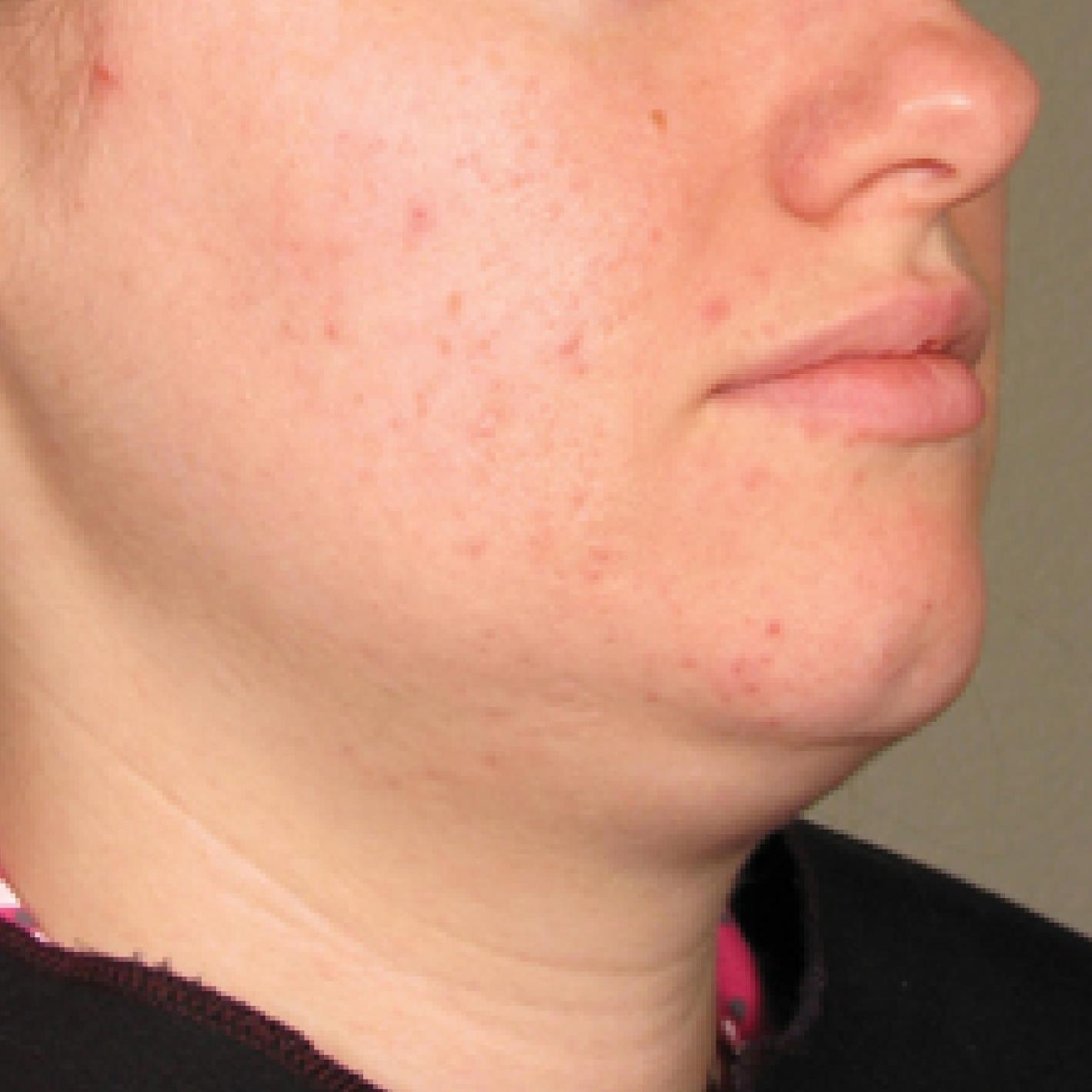 Ultherapy® - Chin: Patient 16 - Before 