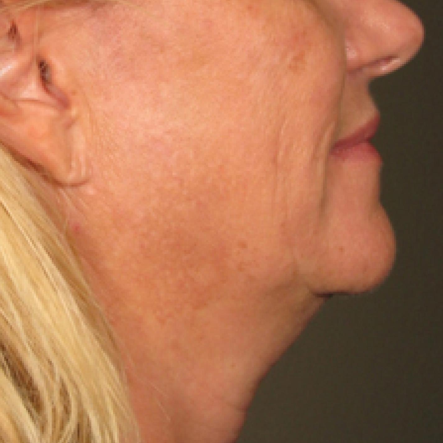 Ultherapy® - Chin: Patient 12 - Before 