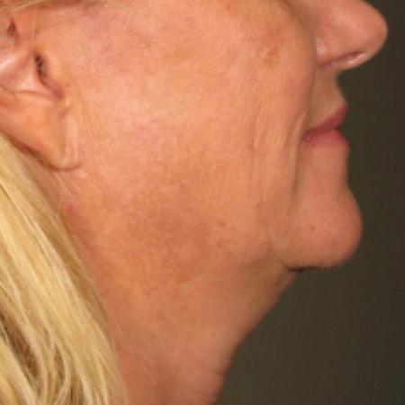 Ultherapy® - Chin: Patient 12 - Before