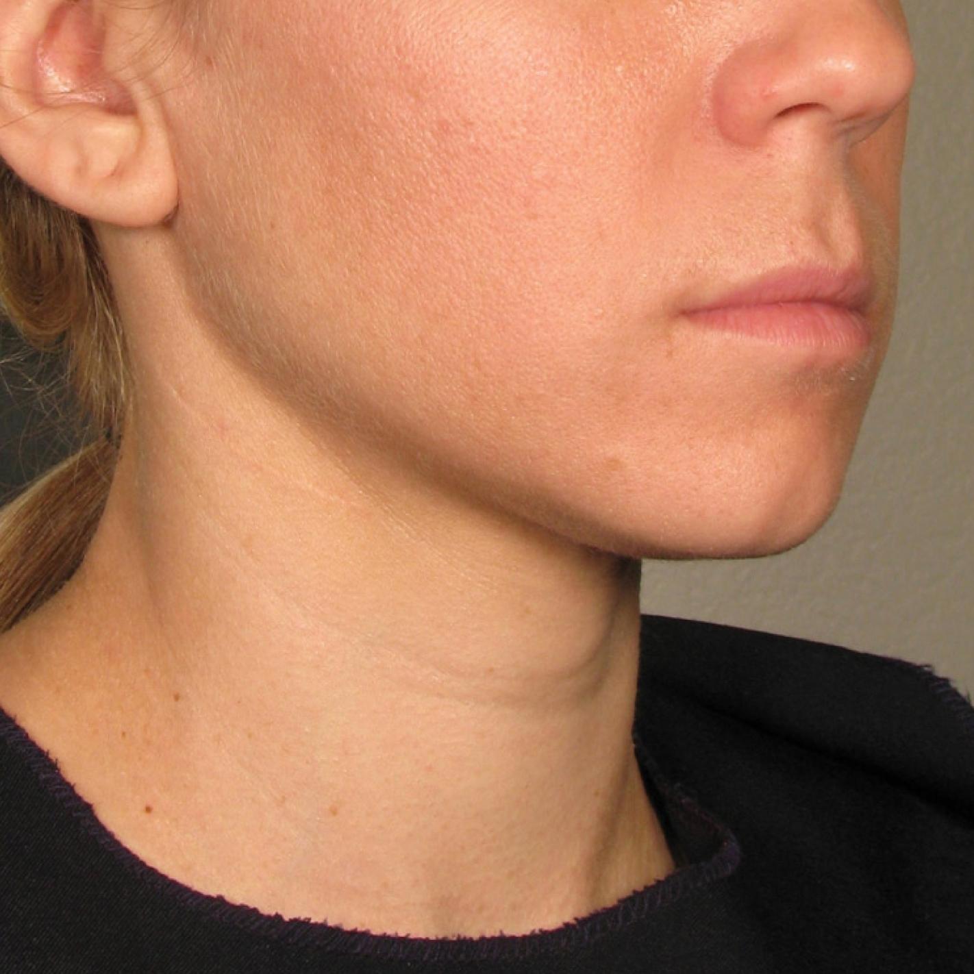 Ultherapy® - Chin: Patient 23 - After 