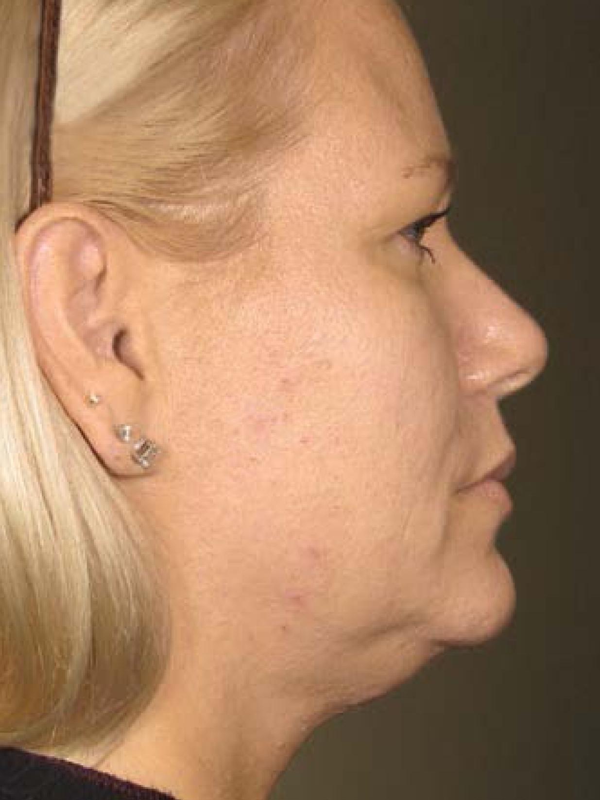 Ultherapy® - Face: Patient 17 - Before 