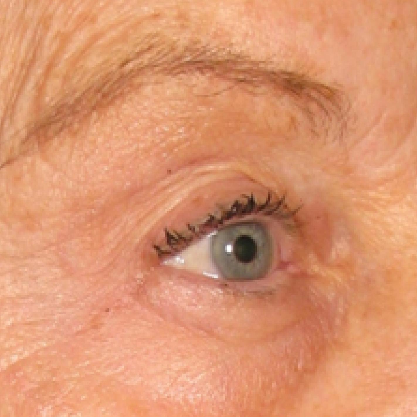 Ultherapy® - Brow: Patient 1 - After 1