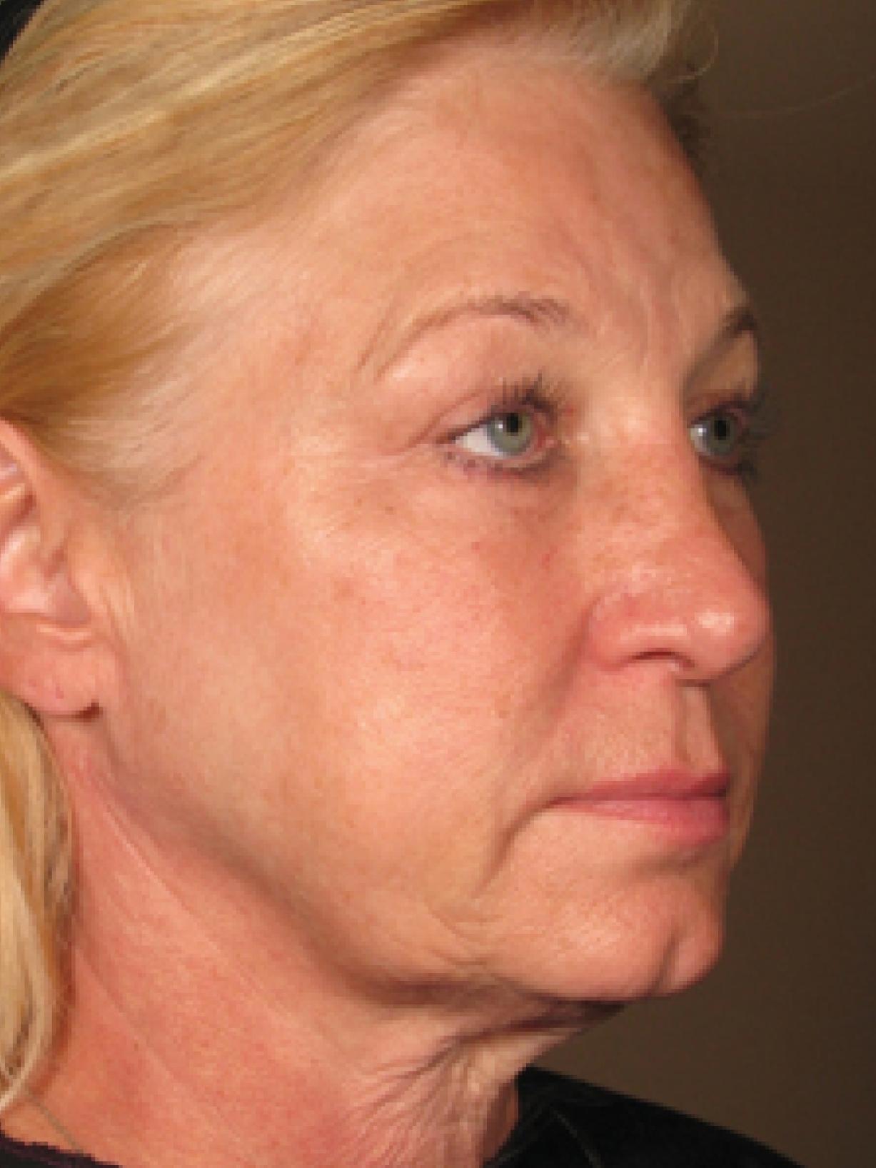 Ultherapy® - Face: Patient 4 - Before 
