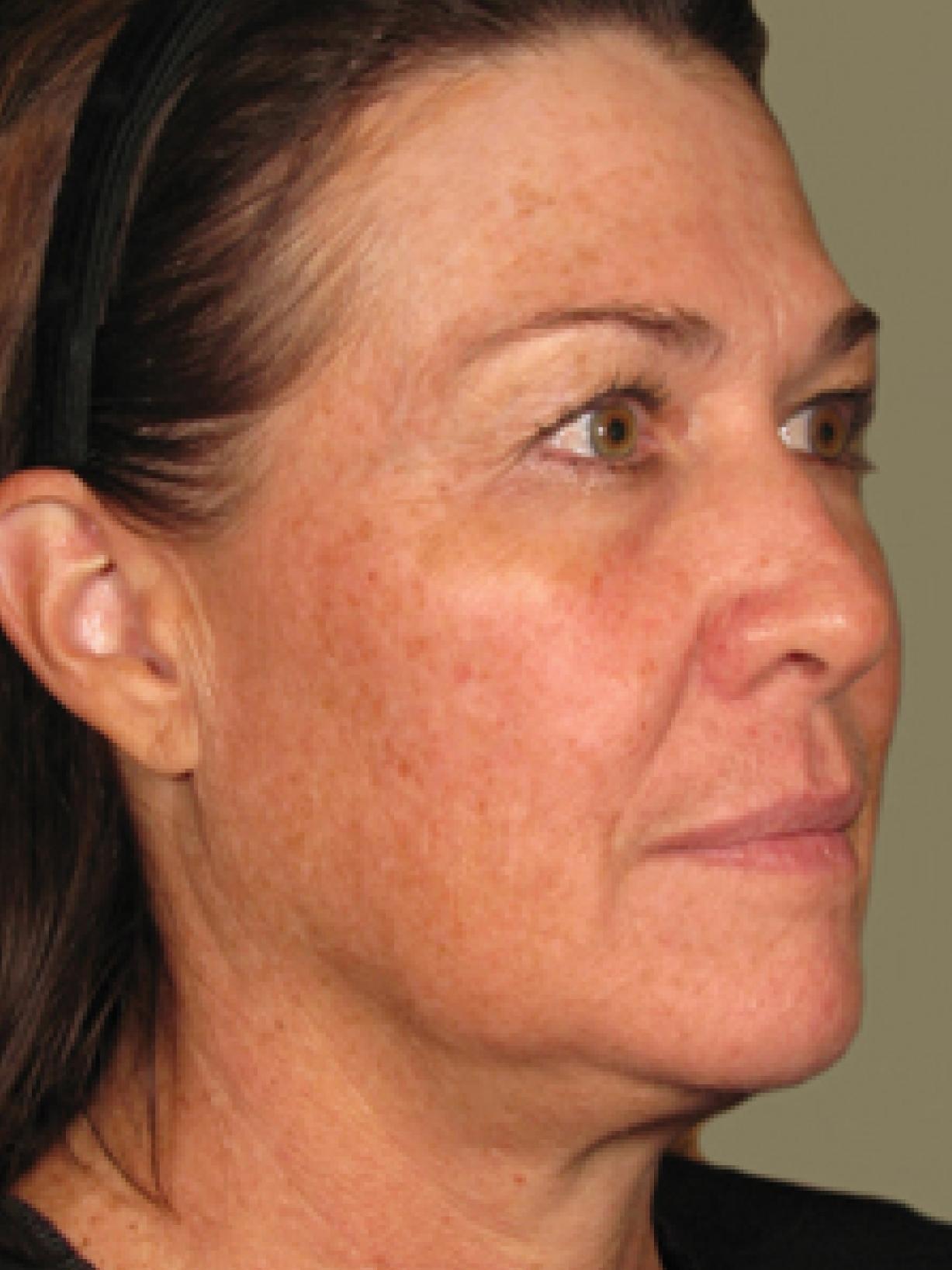 Ultherapy® - Face: Patient 2 - After 1