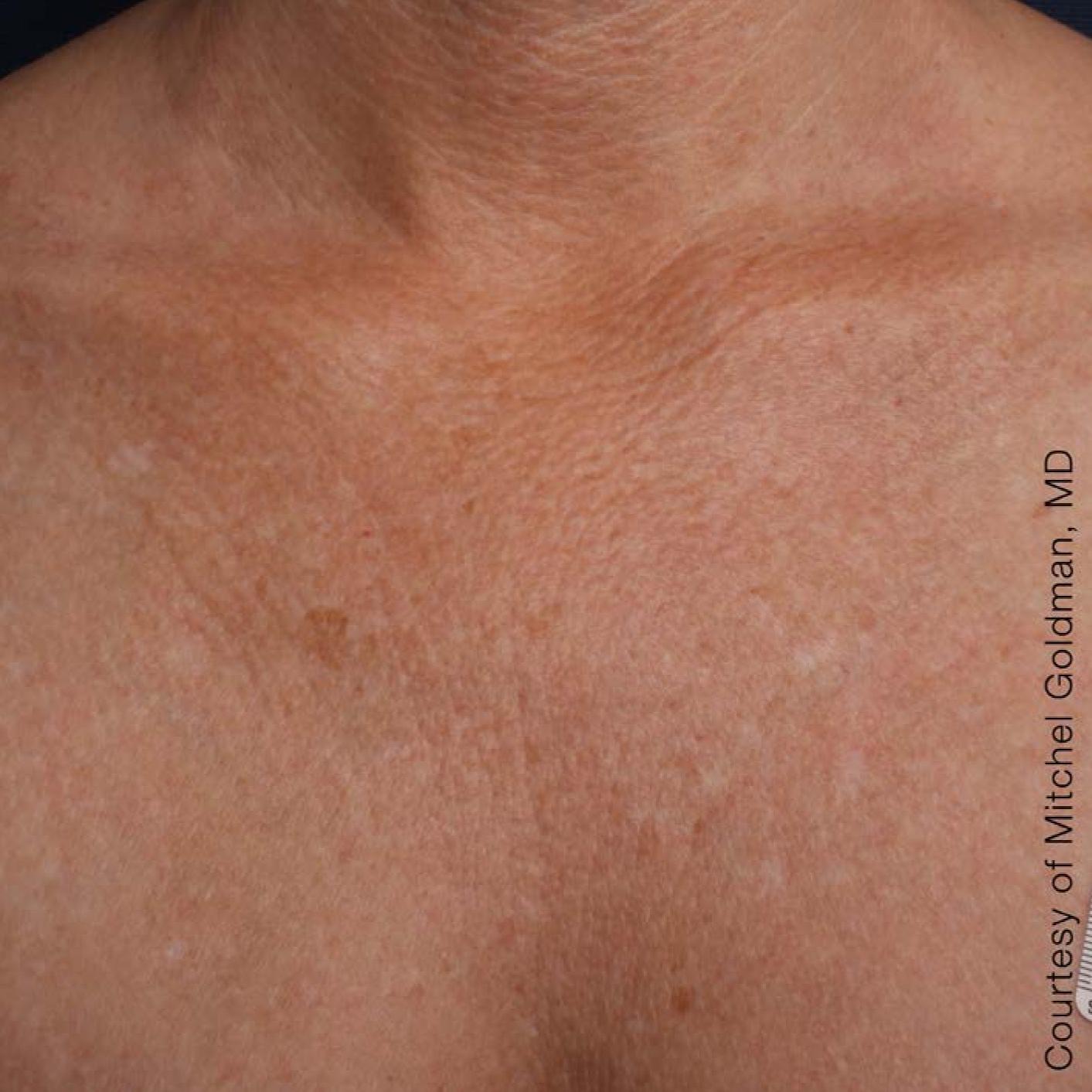 Ultherapy® - Décolletage: Patient 18 - After 