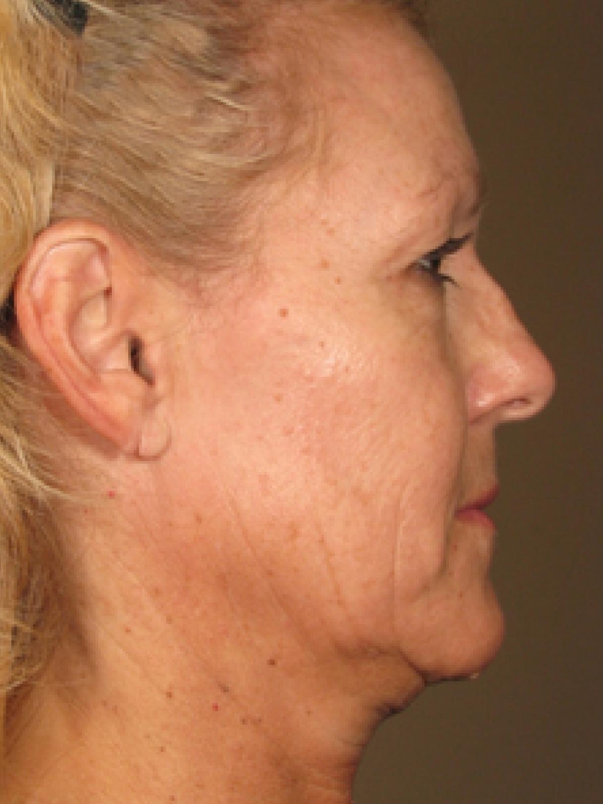 Ultherapy® - Face: Patient 5 - After  