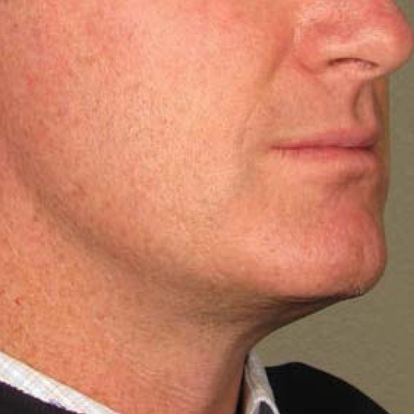 Ultherapy® - Chin: Patient 19 - After 