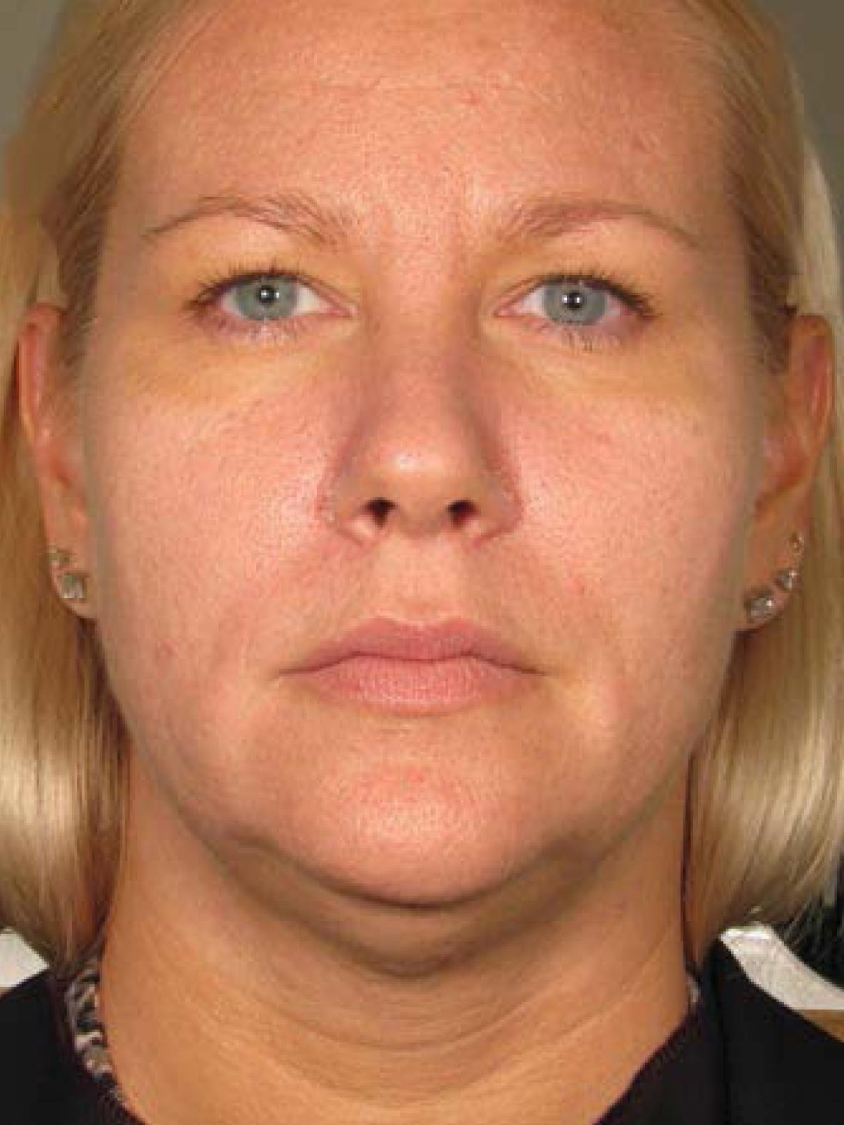 Ultherapy® - Face: Patient 16 - Before 