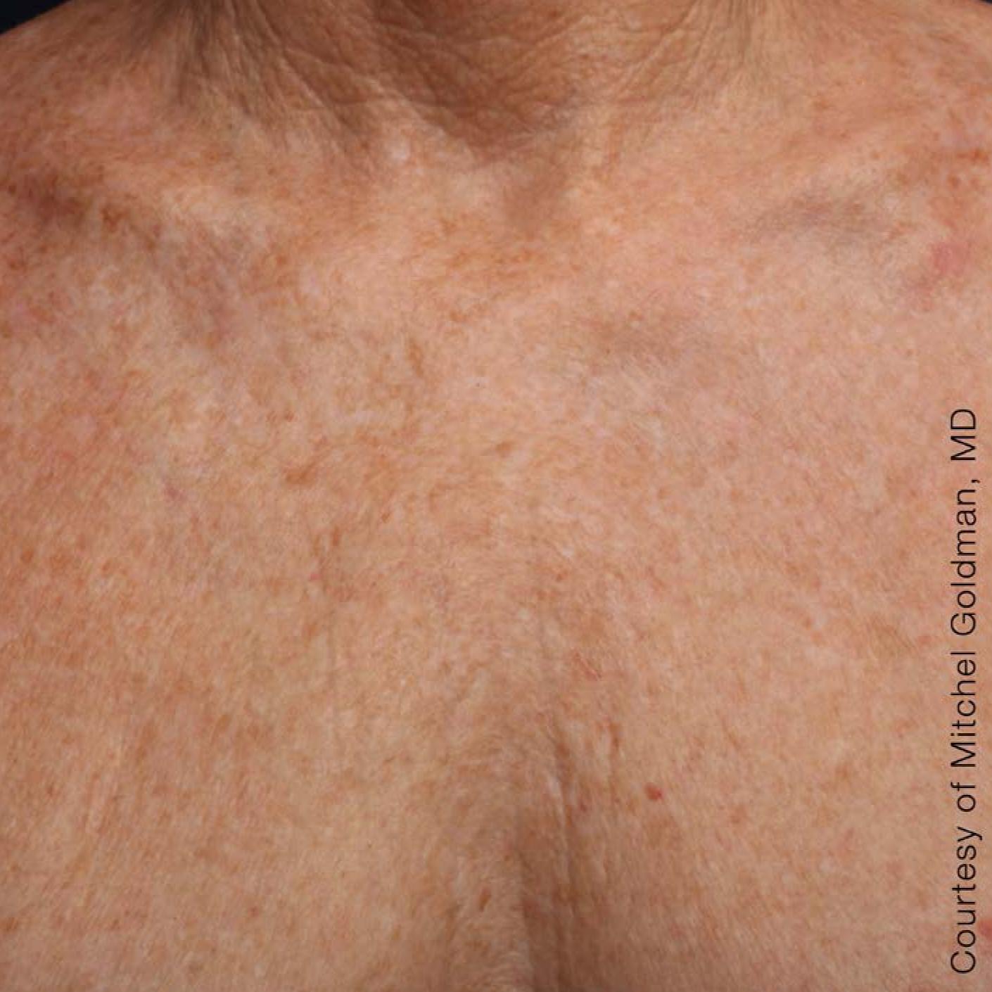 Ultherapy® - Décolletage: Patient 15 - After 