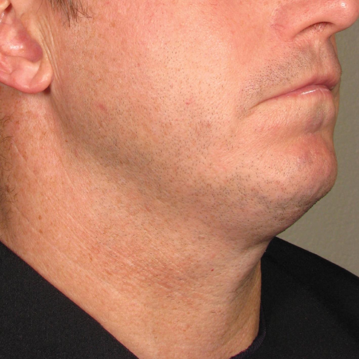 Ultherapy® - Chin: Patient 33 - Before 