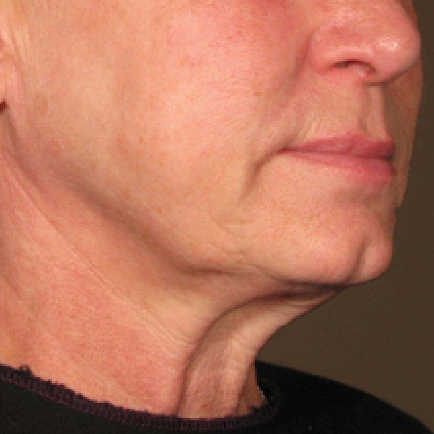 Ultherapy® - Chin: Patient 5 - Before 