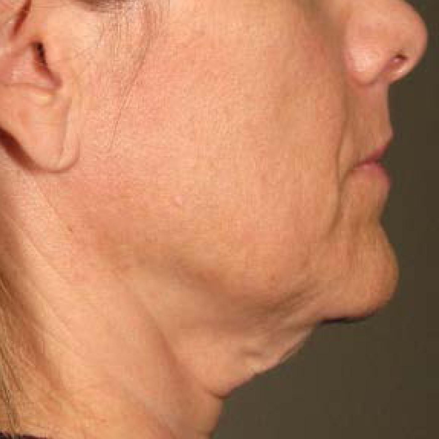 Ultherapy® - Chin: Patient 31 - Before 