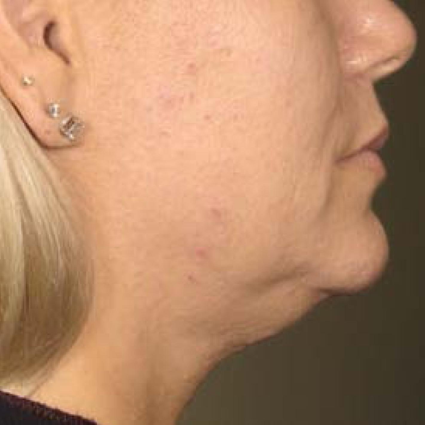 Ultherapy® - Chin: Patient 30 - Before 