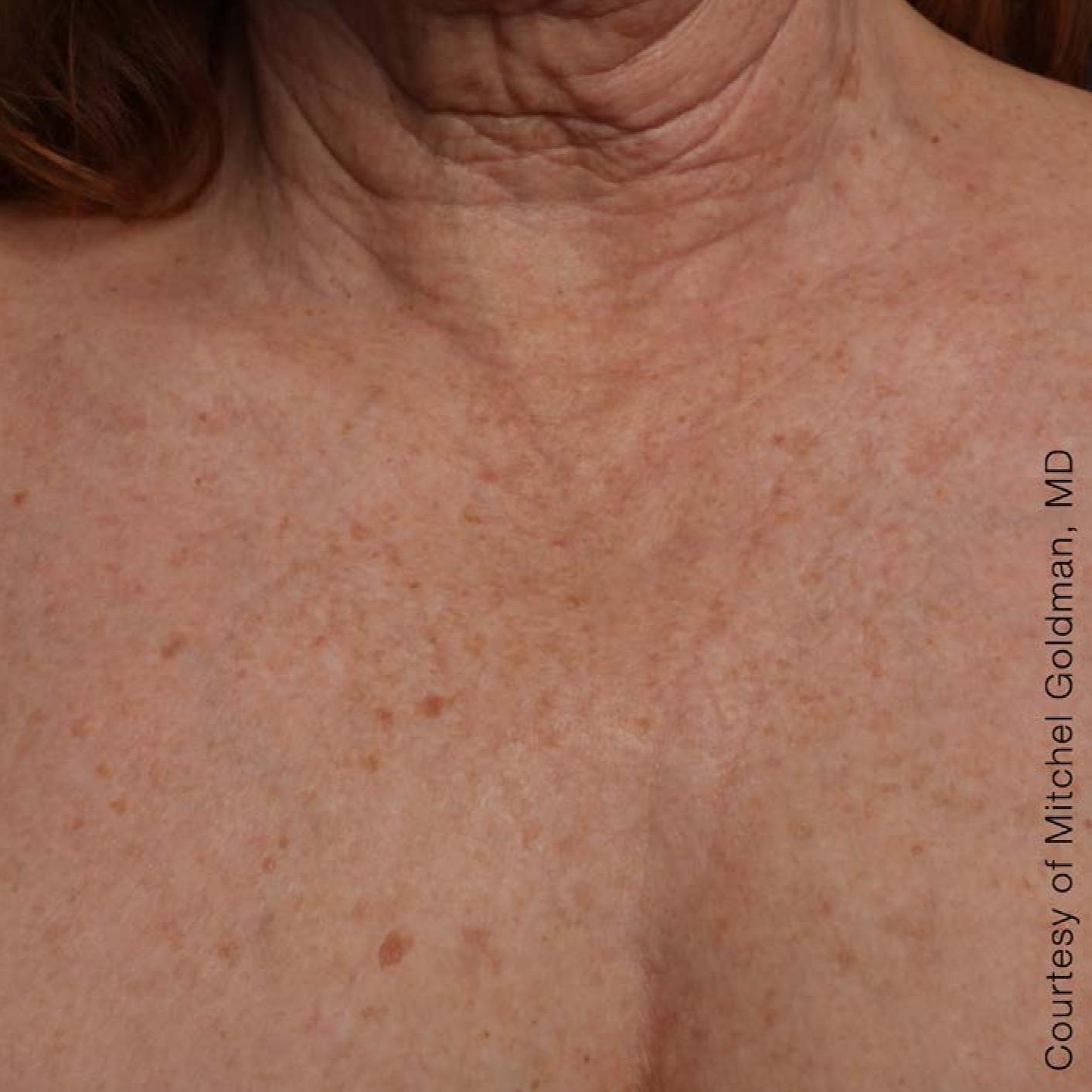 Ultherapy® - Décolletage: Patient 17 - After 1