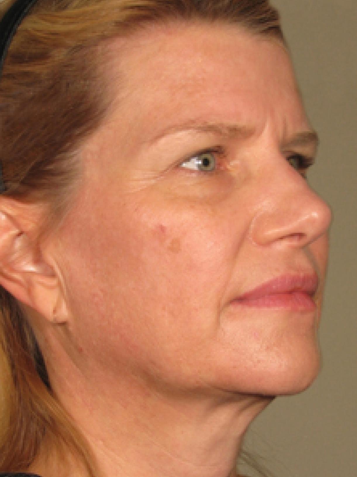 Ultherapy® - Face: Patient 3 - After 1
