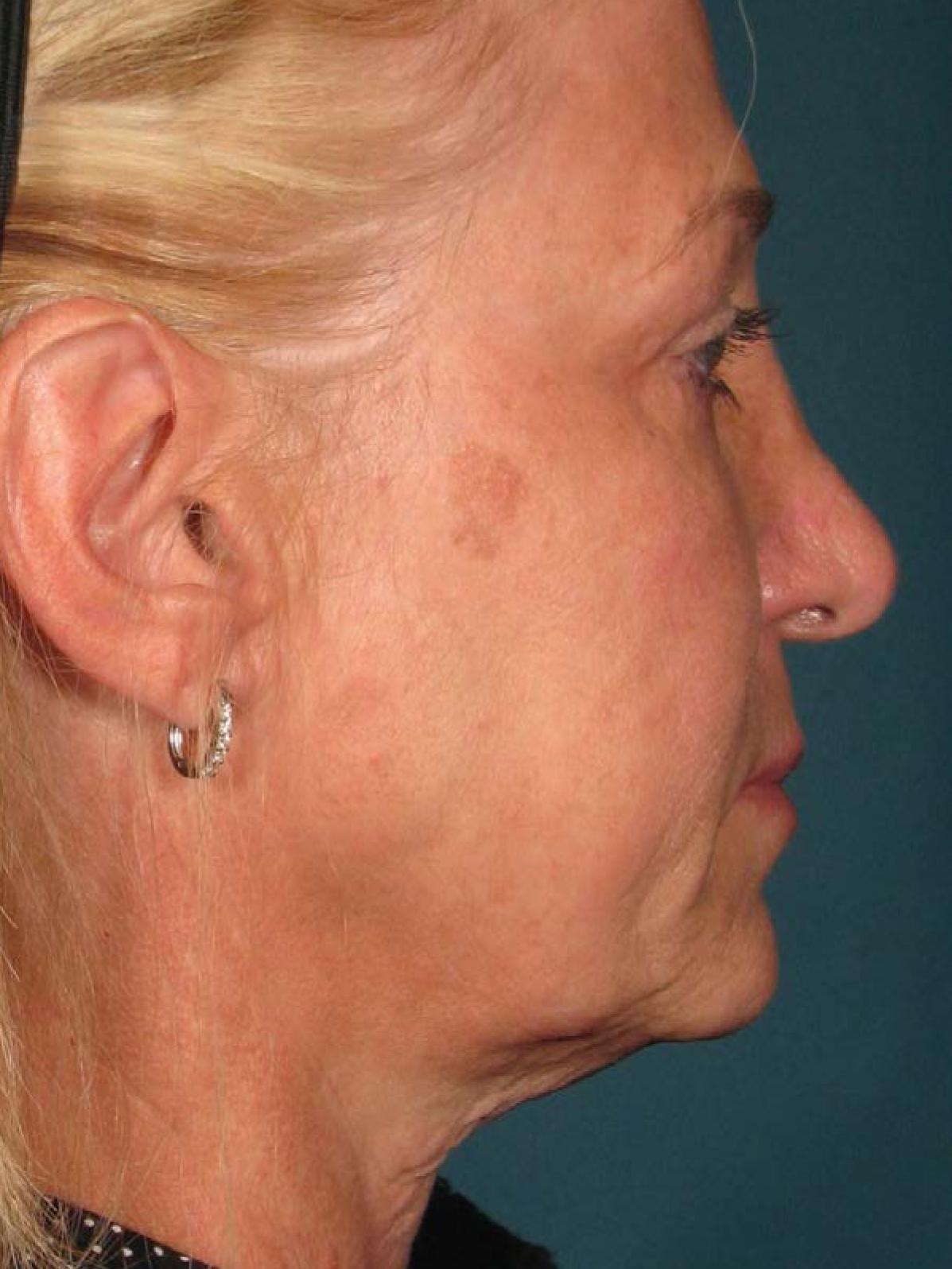 Ultherapy® - Face: Patient 14 - Before 