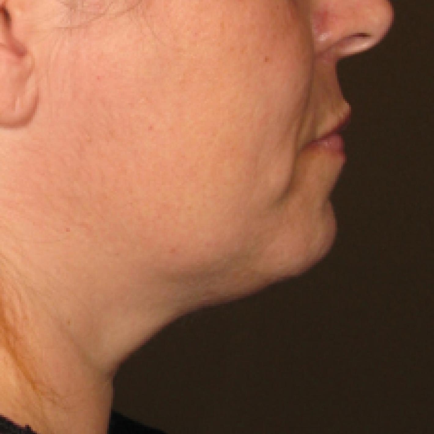 Ultherapy® - Chin: Patient 8 - After  