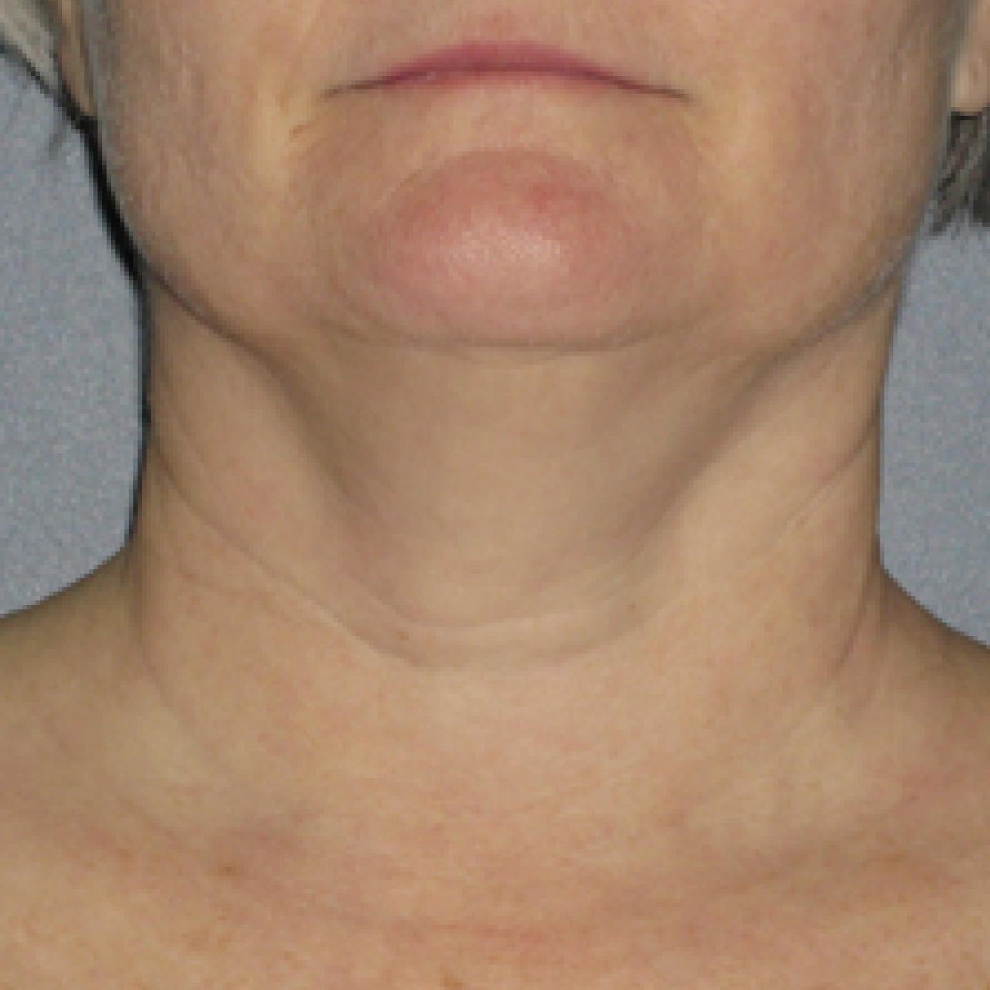 Ultherapy® - Neck: Patient 1 - After  