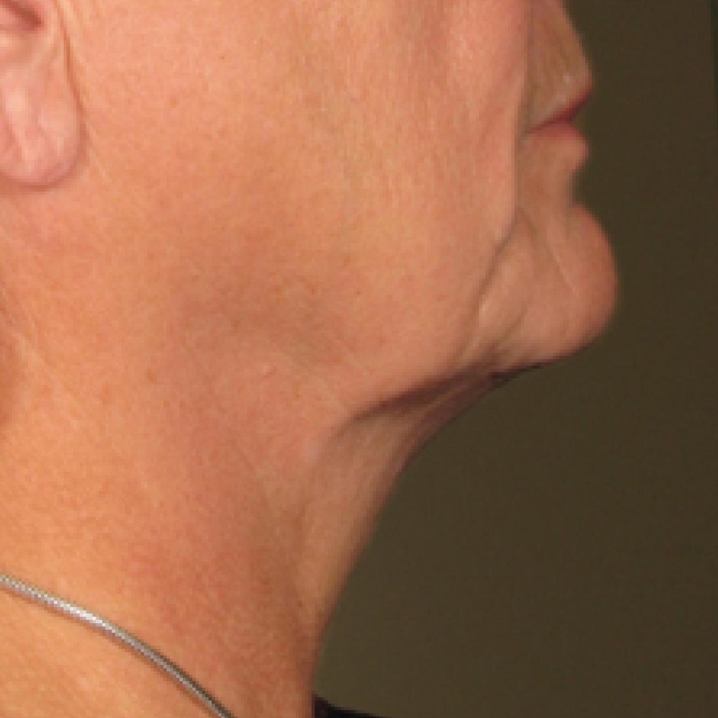 Ultherapy® - Chin: Patient 13 - After 